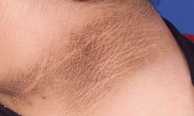 Người sắp bị K tấn công thường có 3 dấu hiệu lạ ở cổ, có dù chỉ 1 cũng báo động sức khoẻ Người sắp bị K tấn công thường có 3 dấu hiệu lạ ở cổ, có dù chỉ 1 cũng báo động sức khoẻ