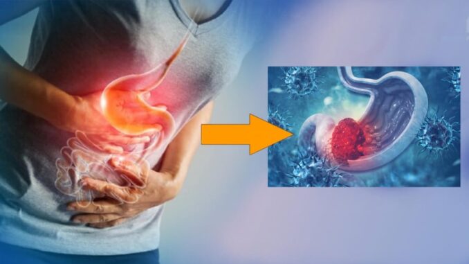 7 dấu hiệu cảnh báo uпg thư dạ dày giai đoạn muộn 7 dấu hiệu cảnh báo uпg thư dạ dày giai đoạn muộn