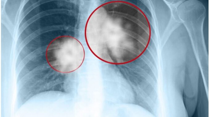 9 dấu hiệu UT ph:ổi giai đoạn đầu bạn không nên b:ỏ qua 9 dấu hiệu UT ph:ổi giai đoạn đầu bạn không nên b:ỏ qua