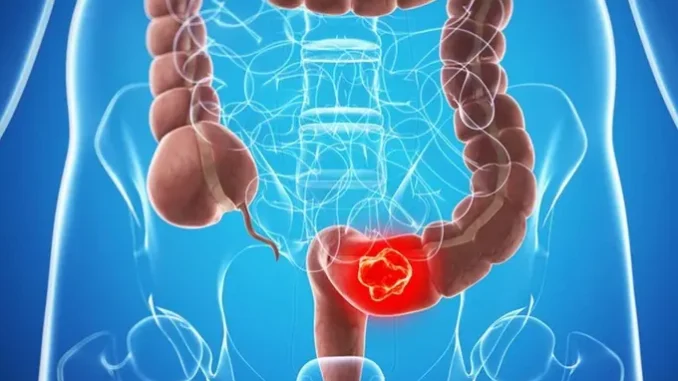 Dấu hiệu sớm cảnh báo ung thư đại tràng Dấu hiệu sớm cảnh báo ung thư đại tràng