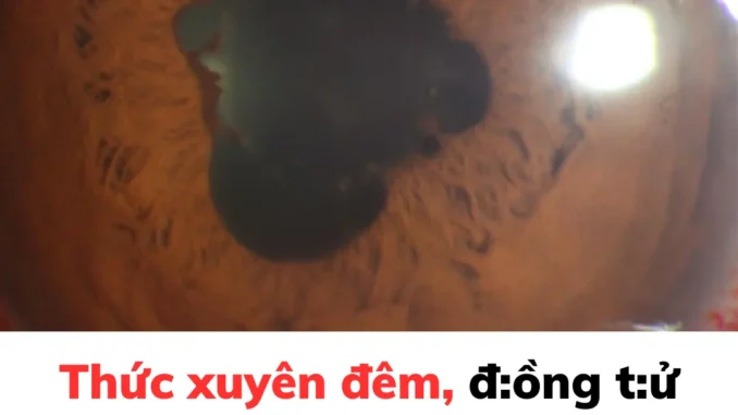 Thức xuyên đêm, đ:ồng tử của người đàn ông biến dạng thành hình cánh hoa Thức xuyên đêm, đ:ồng tử của người đàn ông biến dạng thành hình cánh hoa