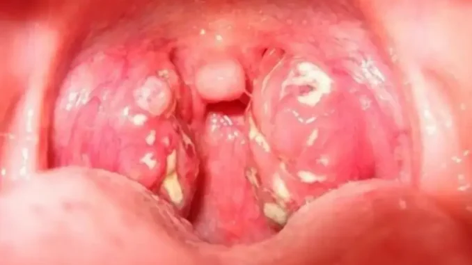 Khi ung thư vòm họng ban đầu “ghé thăm”, cơ thể có thể phát đi 3 “tín hiệu” đỏ, cố gắng đừng phớt lờ Khi ung thư vòm họng ban đầu “ghé thăm”, cơ thể có thể phát đi 3 “tín hiệu” đỏ, cố gắng đừng phớt lờ
