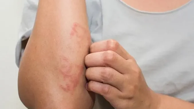 Ngứa ở 7 vị trí này là dấu hiệu cảnh báo khối u ác tính, có 1 cũng nên kiểm tra sức khỏe Ngứa ở 7 vị trí này là dấu hiệu cảnh báo khối u ác tính, có 1 cũng nên kiểm tra sức khỏe