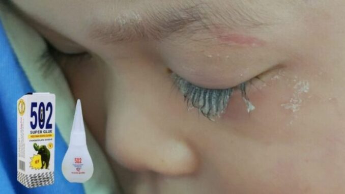 Bé trai 3 tuổi bị keo 502 bắn vào mắt, hành động của người mẹ trong “30 giây vàng” đã cứu con khỏi cảnh m;ù lo;à! Bé trai 3 tuổi bị keo 502 bắn vào mắt, hành động của người mẹ trong “30 giây vàng” đã cứu con khỏi cảnh m;ù lo;à!