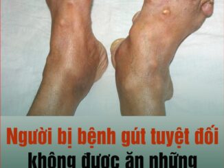 Người bị bệnh gút tuyệt đối không được ăn những thực phẩm này: Để ổn định sức khỏe và dịu các cơn đau