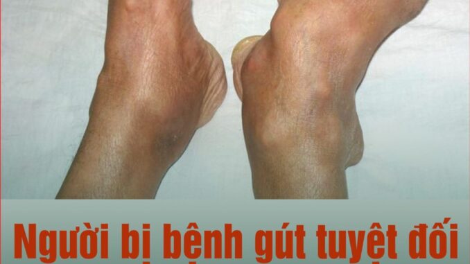 Người bị bệnh gút tuyệt đối không được ăn những thực phẩm này: Để ổn định sức khỏe và dịu các cơn đau Người bị bệnh gút tuyệt đối không được ăn những thực phẩm này: Để ổn định sức khỏe và dịu các cơn đau