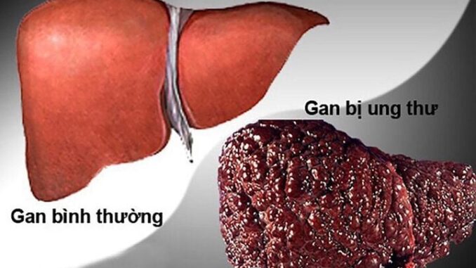 5 dấu hiệu cảnh báo ung thư gan sớm, mơ hồ cũng không nên bỏ qua 5 dấu hiệu cảnh báo ung thư gan sớm, mơ hồ cũng không nên bỏ qua