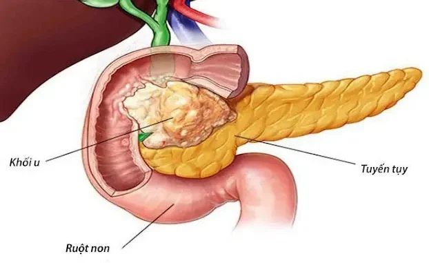 UT lúc đầu không đa:u nhưng thấy 8 dấu hiệu khi đi vệ sinh thì nên đi khám sớm: Đừng chủ quan UT lúc đầu không đa:u nhưng thấy 8 dấu hiệu khi đi vệ sinh thì nên đi khám sớm: Đừng chủ quan