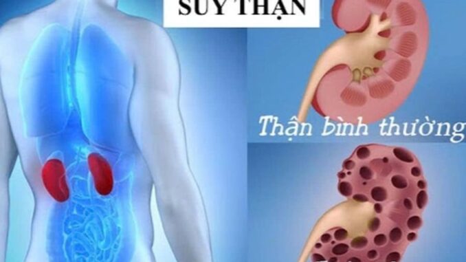 5 dấu hiệu suy thận giai đoạn đầu cần biết: Số 3 nhiều người bị nhưng phớt lờ 5 dấu hiệu suy thận giai đoạn đầu cần biết: Số 3 nhiều người bị nhưng phớt lờ